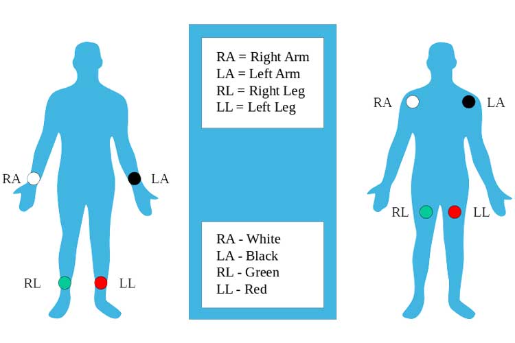 Limb Electrodes - ECG Lead Placement - 12 Lead Placement 
