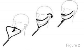 Place the nasal cannula kits onto the patient as shown in Figure 2. Place the nasal cannula kits onto the patient as shown in Figure 2.