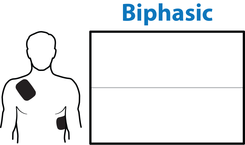 Biphasic Waveform Animation